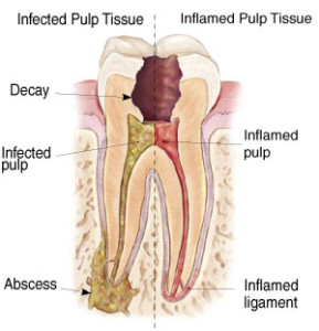 rootcanal treatment image 2