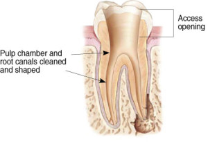 rootcanal treatment image 3