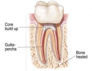 rootcanal treatment image 5