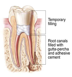 rootcanal treatment image 4